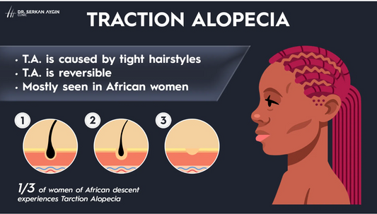 How Not Loving Your Hair Can Give You Alopecia